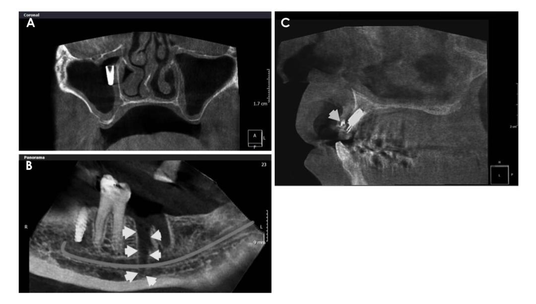 The Occurrence Of Dental Implant Malpositioning And Related Factors A