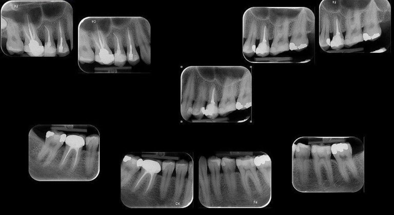 Periapical radiography (PA) - Specialized Radiology Services of Dr ...
