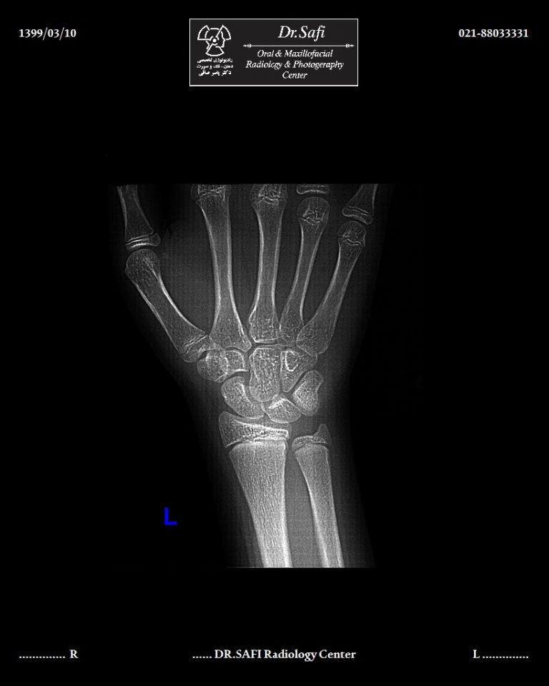 Bone age Assessment Radiography - Specialized Radiology Services of Dr ...