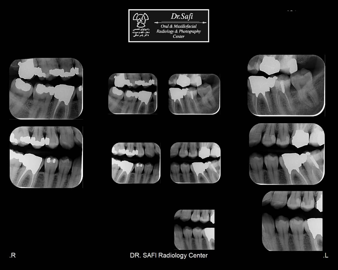 Bitewing radiograohy Specialized Radiology Services of Dr. Yaser Safi’s Center