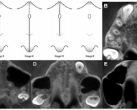 Correlation assessment of cervical vertebrae maturation stage and mid-palatal suture maturation in an Iranian population