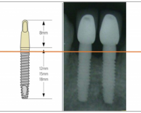 Marginal Bone Loss Around One-Piece Implants: A 10-Year Radiological and Clinical Follow-up Evaluation