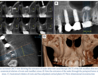 The Applications of Cone-Beam Computed Tomography in Endodontics: A Review of Literature