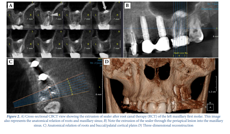 the-applications-of-cone-beam-computed-tomography-in-endodontics-a