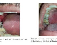 Common conditions associated with mandibular canal widening: A literature review