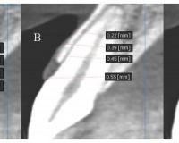 Assessment of gingival biotype and facial hard/soft tissue dimensions in the maxillary anterior teeth region using cone beam computed tomography