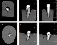 Effect of Object Position in Cone Beam Computed Tomography Field of View for Detection of Root Fractures in Teeth with Intra-Canal Posts