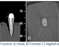 Effect of Metal Artifacts on Detection of Vertical Root Fractures Using Two Cone-Beam Computed Tomography Systems
