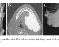 Giant Osteoma of Mandible Causing Dyspnea: A Rare Case Presentation and Review of the Literature