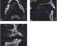 Evaluation By CBCT Of Root and Canal Morphology in Mandibular Premolars in an Iranian Population