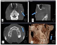 Prevalence of osteoma cutis in the maxillofacial region and classification of its radiographic pattern in cone beam CT
