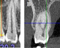 Survey of Anatomy and Root Canal Morphology of Maxillary First Molars Regarding Age and Gender in an Iranian Population Using Cone-Beam Computed Tomography