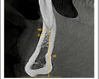 Bone quality and quantity of the mandibular symphyseal region in autogenous bone grafting using cone-beam computed tomography: a cross-sectional study