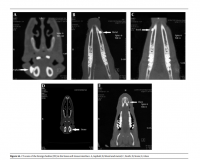Evaluation of Visibility of Foreign Bodies in the Maxillofacial Region: Comparison of Computed Tomography, Cone Beam Computed Tomography, Ultrasound and Magnetic Resonance Imaging
