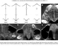 Correlation assessment of cervical vertebrae maturation stage and mid-palatal suture maturation in an Iranian population