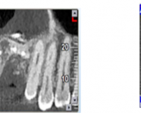 Root Canal Morphology of Maxillary Second Molars according to Age and Gender in a Selected Iranian Population: A Cone-Beam Computed Tomography Evaluation