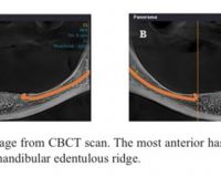 A New Classification of Anterior Mandible Edentulous Ridge Based on Cone Beam Computed Tomography