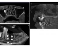 The occurrence of dental implant malpositioning and related factors: A cross-sectional cone-beam computed tomography survey