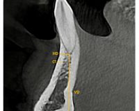 Bone quality and quantity of the mandibular symphyseal region in autogenous bone grafting using conebeam computed tomography: a crosssectional study
