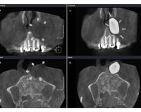 Cone-beam Computed Tomography in Detection of Peripheral Cystic Lesions: A Technical Report