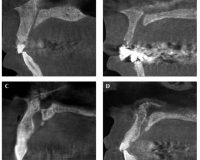 Assessment of Nasopalatine Canal Anatomic Variations Using Cone Beam Computed Tomography in a Group of Iranian Population