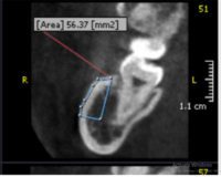 Determination of the Volume and Density of Mandibular Ramus as a Donor Site Using CBCT