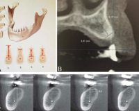 Different methods to evaluate mandibular alveolar ridge in Cone Beam Computed Tomography images in pre-implant surgery assessments