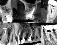 The association of endodontic prognostic factors with the presence of periapical lesion, its volume, and bone characteristics in endodontically treated molars: a cross- sectional study