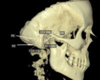 Comparison of data mining algorithms for sex determination based on mastoid process measurements using cone-beam computed tomography