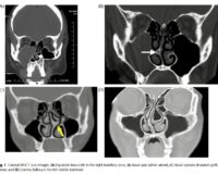Evaluation of diagnostic accuracy of cone beam computed tomography and multi- detector computed tomography for detection of anatomical variations in rhinoplasty