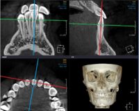 Correlation of Tongue Dimensions and Posture with Lower Central Incisor Inclination and Alveolar Bone Thickness in Skeletal Class I and II Malocclusion: A CBCT Study