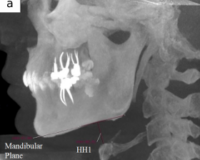 Effect of Muller maneuver on upper airway  characteristics and surrounding structures in  patients with obstructive sleep apnea: a cone beam computed tomography study