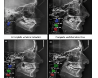 Automated assessment of cervical vertebral maturation stages on lateral cephalometric radiographs using a two-stage deep learning framework