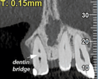 Rare  spontaneous  formation  of  a  dentin  bridge  post-dental  trauma:  A  cone  beam  computed  tomography-based  case  report  with  root  canal  therapy