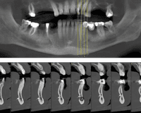 Morphometric analysis of the mandibular  incisive canal using cone beam computed  tomography images
