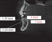 ComparativeEvaluationofBuccalCorticalBone ThicknessinthePosteriorMandibleAcrossSkeletal Patterns:ACBCTStudyinaSampleofIranians