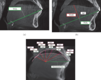 TheRelationBetweenPostureandDimensionofTongue andDifferentSagittalSkeletalPatternsandVerticalSkeletal PatternsinClassIandClassIIPatients:ACBCTStudy