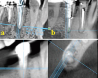 Cross-SectionalStudyontheRelationshipofSome PrognosticFactorsofEndodonticTreatmentWiththe PresenceandSizeofPeriapicalLesionsinEndodontically TreatedMandibularAnteriorandPremolarTeethUsing Cone-BeamComputedTomography