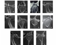 Bony Changes of the Temporomandibular Joint in Symptomatic Versus Asymptomatic Individuals: Insights from CBCT Imaging